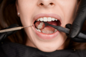 Seal the Deal on Healthy Smiles: A Guide to Dental Sealants in Union City