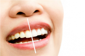 Smile Brighter, Shine Bolder: The Art and Science of Cosmetic Teeth Whitening
